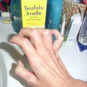 Claw chart (or due to current events: Sulcus Ulnaris Syndrome Chart)